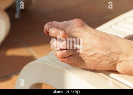 Schwere Bunion, auch bekannt als Hallux Valgus zu Fuß einer älteren Frau, die sich auf einer Sonnenliege ausruhte, Nahaufnahme Detail Stockfoto