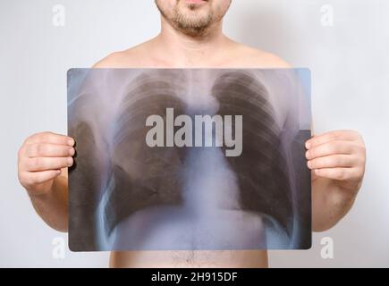 Ein Mann hält ein Bild einer Röntgenaufnahme seiner Lunge in der Nähe seiner Brust. Stockfoto