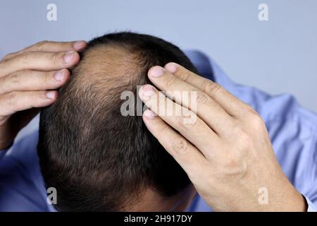 Mann besorgt über Haarausfall. Kahlheit, männliche Hände auf einer Glatze Stockfoto