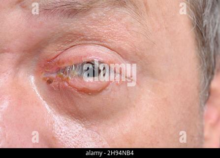 Ein Auge mit bakterieller Purulenz-Konjunktivitis, auch als rosa Auge bekannt. Stockfoto