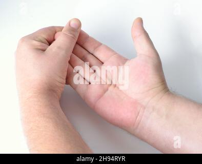 Dupuytren-Kontraktur, auch Dupuytren-Krankheit, Morbus Dupuytren, Wikingerkrankheit und keltische Hand genannt. Inspektion. Stockfoto