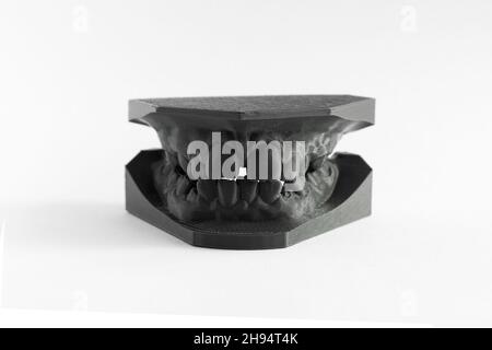 3D Drucker Prothese Mädchen 9 Jahre Zahnmedizin Stockfoto