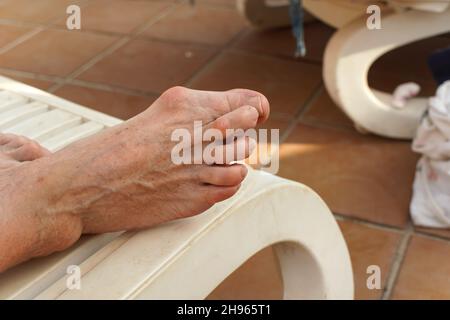 Schwere Bunion, auch bekannt als Hallux Valgus zu Fuß einer älteren Frau, die sich auf einer Sonnenliege ausruhte, Nahaufnahme Detail Stockfoto