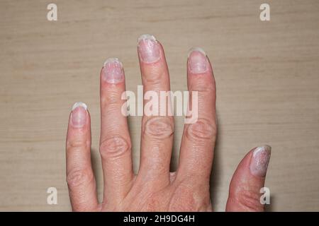 Nahaufnahme von schuppig gebissenen und brüchigen Nägeln ohne Maniküre. Nachwachsende Nagelhaut und beschädigte Nagelplatte nach dem Gelpolitur. Gesundheit und Schönheit Problem Stockfoto