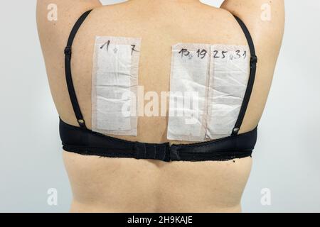 Patch-Tests auf dem Rücken einer Frau, Test auf Hautallergene, Kontaktallergene, Konzept der dermatologischen und allergischen Probleme Stockfoto