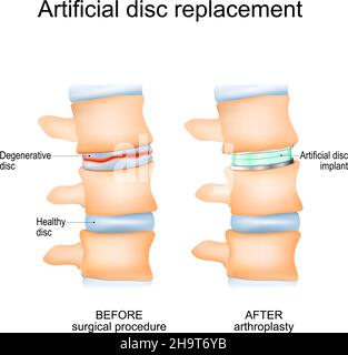 Arthroplastik der Bandscheiben. Nahaufnahme einer menschlichen Wirbelsäule vor dem chirurgischen Eingriff und nach der Arthroplastik. Degenerative Disc und künstliche Stock Vektor