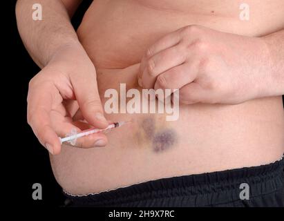 Insulininspritze in den Bauch. Haut mit Hämatom nach Injektion. Stockfoto