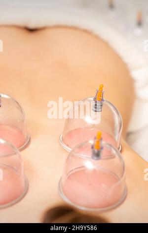 Junge kaukasische Frau erhält Schröpftherapie in Spa-Klinik. Islamische Frauenheilkunde Stockfoto
