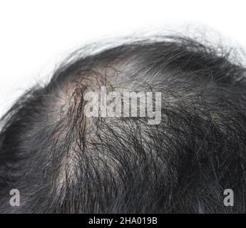 Dünner werdendes oder spärliches Haar, Haarausfall nach männlichem Muster im südostasiatischen, chinesischen älteren Mann. Isoliert auf Weiß. Stockfoto