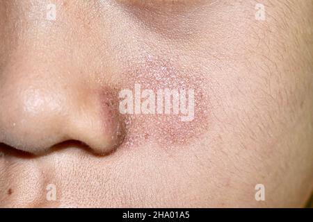 Tinea faciei oder Fungal-Infektion auf dem Gesicht des südostasiatischen, birmanischen zwei Jahre alten Kindes Stockfoto