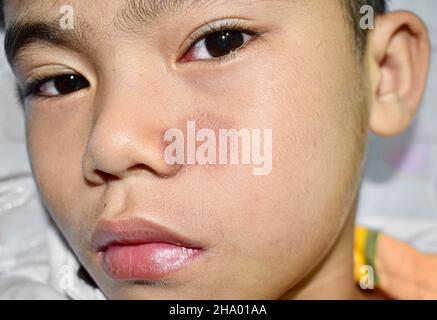 Tinea faciei oder Fungal-Infektion auf dem Gesicht des südostasiatischen, birmanischen zwei Jahre alten Kindes Stockfoto
