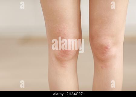 Hautallergien, Beine Haut Frauen. Nahaufnahme von roten Pusteln am Knie, einer allergischen Reaktion, die durch atopische Dermatitis verursacht wird. Ausgewählter Fokus. Stockfoto