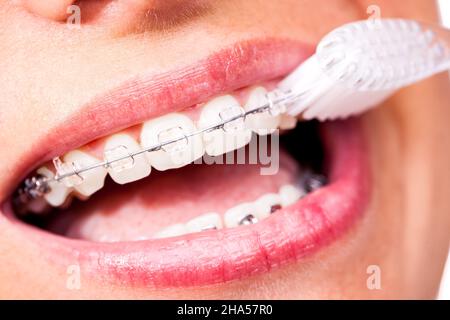 Zahnspangen, Mund, Frau, Zahnbürste, sauber, Reinigung, Zähne, Zahnaufhellung, Gesundheit, Hygiene, Korsett, Lippen, schön, Glanz, offen, Bürste, schräg, Regulierung Stockfoto