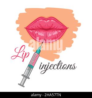 Injektion einer Lippenspritze zur Verstärkung durch Hyaluronsäure-Füllstoff. Medizinische Schönheit Gesicht Verfahren Zeichen. Kosmetische Hautstraffung, plastische Chirurgie. Vektor Stock Vektor