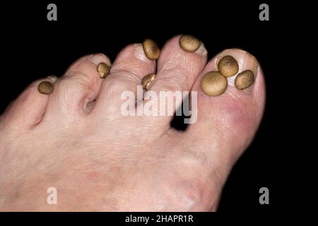 Symbolisches Foto, Onychomykose, auch bekannt als Tinea unguium, Pilzinfektion des Nagels Stockfoto