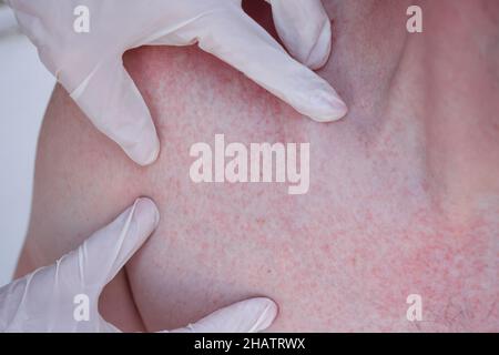 Arzt Hände in Handschuhen, die roten Hautausschlag auf der Haut des Patienten untersuchen Stockfoto