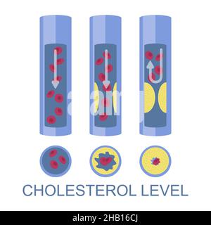 Niedriger, normaler, hoher Cholesterinspiegel, Vektordarstellung. Hoher ldl-Risikofaktor für Herzerkrankungen, Atherosklerose. Stock Vektor