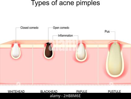 Arten von Akne Pickel. Querschnitt der menschlichen Haut mit Akne vulgaris. Whitehead, Blackhead, Papule und Pustule. vektordiagramm. Stock Vektor