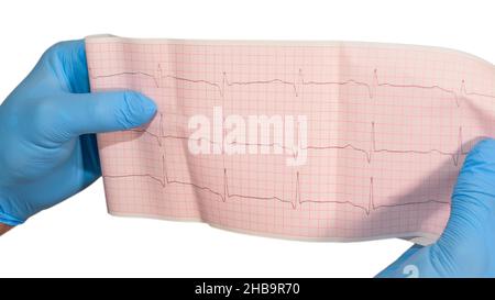 Herzkardiogramm in den Händen eines Arztes. Der Arzt analysiert Herzerkrankungen anhand des Kardiogramms Stockfoto