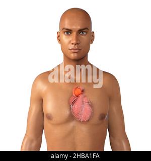 Aortenaneurysma. Computer Bild zeigt ein Aneurysma in der Aorta ascendens. Stockfoto