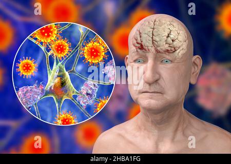 Infektiöse Ätiologie der Demenz. Konzeptionelle Computerdarstellung, die eine ältere Person mit Alzheimer-Krankheit, fortschreitenden Beeinträchtigungen der Hirnfunktionen, Amyloidplaques im Gehirn und Viren zeigt, die Neuronen angreifen. Stockfoto