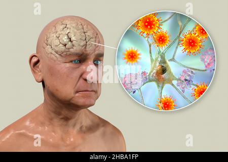 Infektiöse Ätiologie der Demenz. Konzeptionelle Computerdarstellung, die eine ältere Person mit Alzheimer-Krankheit, fortschreitenden Beeinträchtigungen der Hirnfunktionen, Amyloidplaques im Gehirn und Viren zeigt, die Neuronen angreifen. Stockfoto