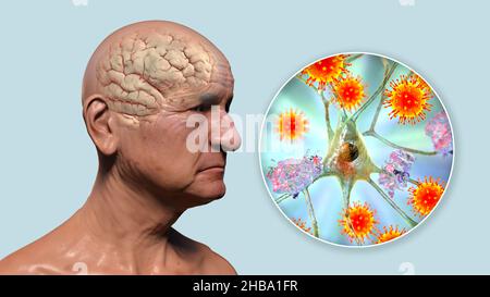 Infektiöse Ätiologie der Demenz. Konzeptionelle Computerdarstellung, die eine ältere Person mit Alzheimer-Krankheit, fortschreitenden Beeinträchtigungen der Hirnfunktionen, Amyloidplaques im Gehirn und Viren zeigt, die Neuronen angreifen. Stockfoto