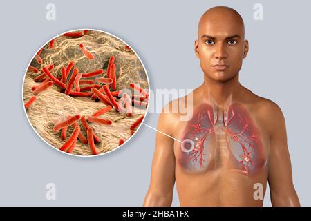 Illustration der faserig-kavernösen Lungentuberkulose mit einer Nahaufnahme der Mycobacterium tuberculosis-Bakterien, dem Erreger der Tuberkulose. In der rechten Lunge befindet sich eine Höhle (Kavität) mit einer gut gebildeten faserigen Schicht in der Wand. Stockfoto