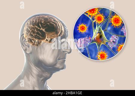 Infektiöse Ätiologie der Demenz. Konzeptuelle Computerdarstellung eines älteren Menschen mit Alzheimer-Krankheit, fortschreitenden Beeinträchtigungen der Hirnfunktionen, Amyloid-Plaques im Gehirn und Viren, die Neuronen angreifen. Stockfoto