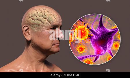 Infektiöse Ätiologie der Demenz. Konzeptionelle Computerdarstellung, die eine ältere Person mit fortschreitenden Beeinträchtigungen der Gehirnfunktionen und Viren zeigt, die Neuronen angreifen. Stockfoto