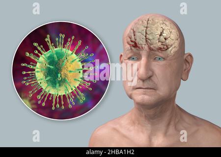 Infektiöse Ätiologie der Demenz. Konzeptionelle Computerdarstellung, die eine ältere Person mit fortschreitenden Beeinträchtigungen der Gehirnfunktionen und Viren zeigt, die Neuronen angreifen. Stockfoto