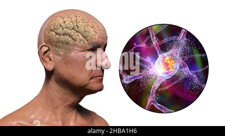 Demenz und Alzheimer-Krankheit. Konzeptionelle Computerdarstellung, die Neurodegeneration und fortschreitende Beeinträchtigung der Hirnfunktionen bei älteren Menschen zeigt. Stockfoto