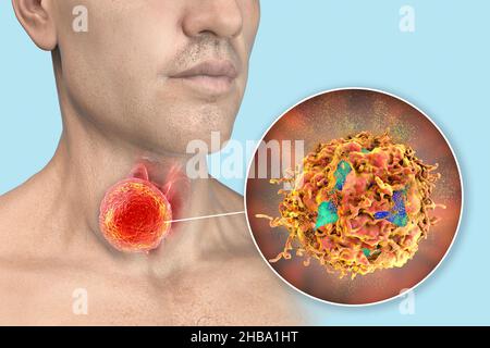 Behandlung von Schilddrüsenkrebs. Konzeptionelle Computerdarstellung von Schilddrüsenkrebs mit einer Nahaufnahme der Zerstörung von Krebszellen. Stockfoto