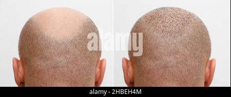 Der Kopf eines baldierenden Mannes vor und nach der Haartransplantation. Ein Mann, der seine Haare verliert, ist zottelig geworden. Ein Werbeplakat für ein Haar Stockfoto