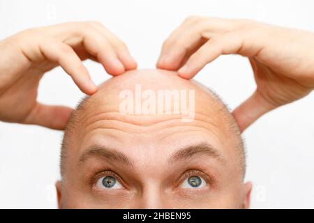 Der Kopf eines baldierenden Mannes. Ein kahler Mann war wegen des Haarausfalls verärgert. Behandlung von Haarausfall. Stockfoto