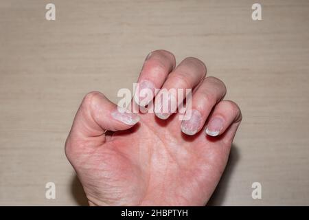 Nahaufnahme von gebissenen und brüchigen Nägeln ohne Maniküre. Überwucherte Nagelhaut-Fingernägel und befleckte Nagelplatte. Nagelhaut überwuchert Nägel und beschädigte Nagel Stockfoto