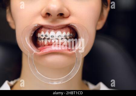 Eine junge Frau mit Metallspangen wird von einem Kieferorthopäden untersucht. Korrektur des Gebisses in der Zahnklinik. Konzept der gesunden Zähne. Stockfoto