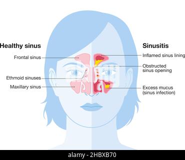 Vektor-Illustration zeigt gesunde Sinus und Sinusitis mit entzündeten Futter, verstopfte Sinusöffnung, Adinoid und überschüssigen Schleim Stockfoto