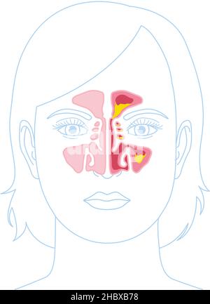 Vektor-Illustration zeigt gesunde Sinus und Sinusitis mit entzündeten Futter, verstopfte Sinusöffnung, Adinoid und überschüssigen Schleim Stockfoto