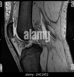 Magnetresonanzbild des Kniegelenks (MRT-Knie) in sagittalem Plan, der einen vollständigen vorderen Kreuzbandriss (ACL-Träne) zeigt Stockfoto