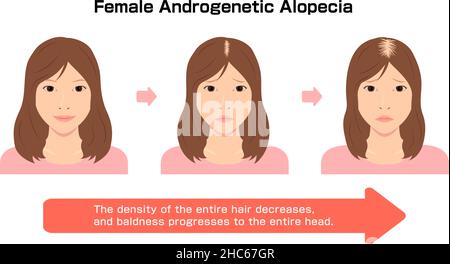 Fortschritt der weiblichen androgenetischen Alopezie. Vektorgrafik Stock Vektor