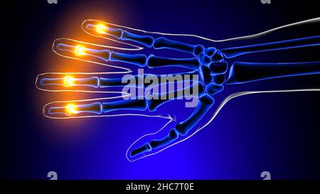 Distale Schmerzen in den interpals-gealen Gelenken Anatomie für medizinisches Konzept 3D Illustration Stockfoto