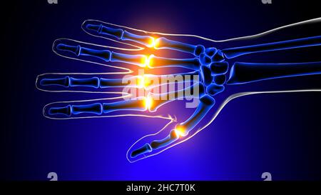 Metacarpophalangealgelenke Schmerzen Anatomie für medizinisches Konzept 3D Illustration Stockfoto