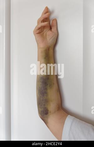 Schwere Blutergüsse am Arm nach koronarer Angioplastie bei einer weiblichen Patientin Stockfoto