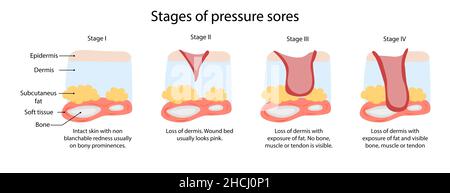 Stufen von Druckgeschwüren, einfache Illustration Stockfoto
