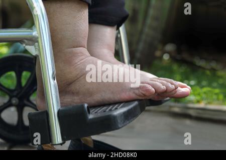 Ältere Frau geschwollene Füße drücken Sie die Taste Test auf Rollstuhl Stockfoto