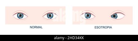 Esotropie. Horizontaler Strabismus vor und nach der Operation. Falsche Ausrichtung der Augen, Kreuzäugiger Zustand. Menschliche Augen gesund und mit nach innen gerichteten Blickpositionen. Doppelblick. Vektorgrafik Cartoon-Illustration Stock Vektor