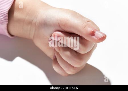 Virale Warze (Verruca) auf dem Finger Nahaufnahme auf weißem Hintergrund. Hauterkrankung, die durch eine Art von humanem Papillomavirus HPV verursacht wird. Stockfoto