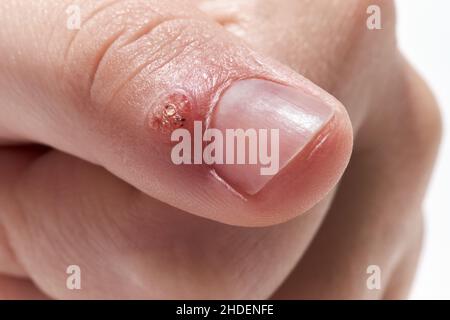 Virale Warze (Verruca) auf dem Finger Nahaufnahme auf weißem Hintergrund. Hauterkrankung, die durch eine Art von humanem Papillomavirus HPV verursacht wird. Stockfoto