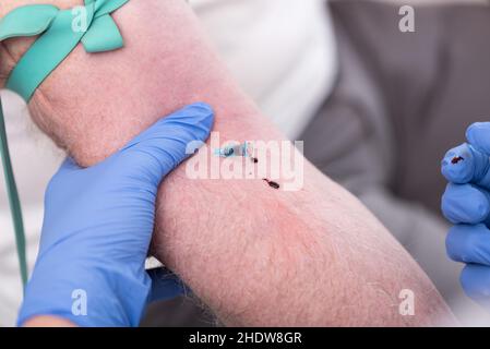 Katheter in die Vene eines Patienten gelegt Stockfoto